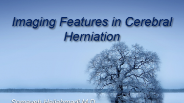 Imaging Features in Cerebral Herniation-2